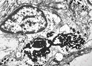 M,29y. | spleen - dyserythropoetic anemia - complex siderosomes M,29y. | spleen - dyserythropoetic anemia - complex siderosomes